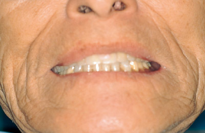 [写真] レジンを盛り上げた義歯を口腔内に挿入し、中心咬合位で咬合させる