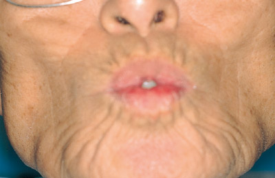 [写真] 十分に咬合させたところで、口角牽引・口唇突出などの一連の機能運動を行う