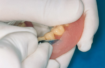 [写真] 人工歯面に流れたレジンはエバンスなどで除去する