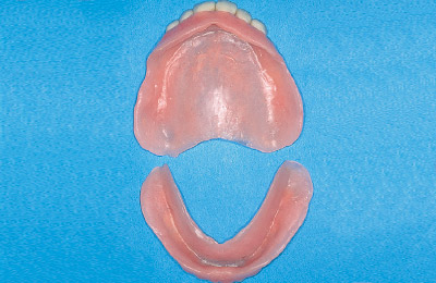 [写真] 旧義歯粘膜面