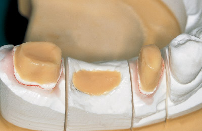 [写真] 支台歯にCRセップⅢを塗布後、ペースト（ODA3）築盛
