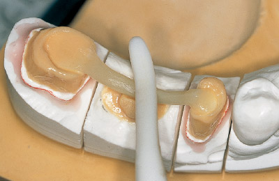 [写真] 図25で重合したポンティック基底面のペースト上に適量のペースト（ODA3）を盛り、フレームを支台歯の形に合うまで圧接する