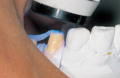[写真] 小臼歯側の光照射