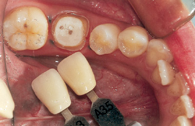 [写真] 支台歯形成終了後の口腔内所見