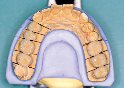 [写真] かつ歯冠色を示すハイブリッドセラミックス
