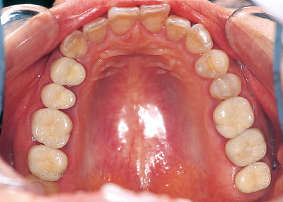 [写真] 歯冠色修復
