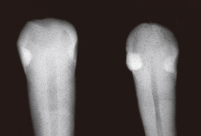 [写真] 犬歯に3級窩洞を形成し修復　左側の歯牙は1mm強の浅い窩洞、右側の歯牙は2mm弱の深い窩洞