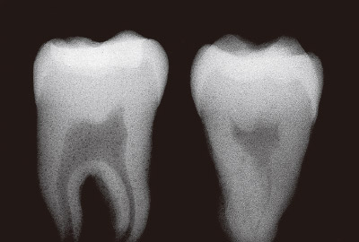 [写真] 下顎大臼歯の咬合面の裂溝部に幅深さともに1mm強の1級窩洞を形成して修復　左の歯牙がクリアフィルフローFXによる修復、右の歯牙が他社の製品による修復
