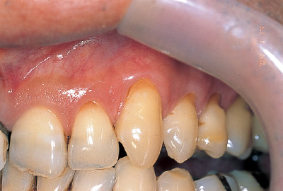 [写真] 上顎左側切歯、犬歯、小臼歯の歯頸部の楔状欠損