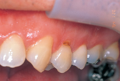 [写真] 左上顎第一小臼歯の歯頸部のう蝕