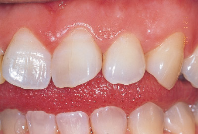 [写真] 左上顎中切歯遠心の小さなう蝕（3級窩洞）