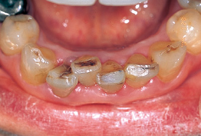 [写真] 下顎前歯部切縁のう蝕