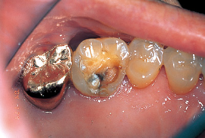 [写真] 左上顎第一大臼歯咬合面のインレー脱落後のう蝕