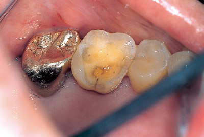 [写真] 感染歯質除去後、クリアフィルフローFX（シェード：A3）によるライニング