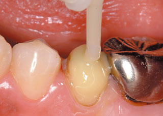 歯冠部の築盛を行う写真
