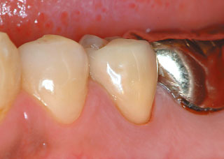 歯冠補綴処置完了時の写真