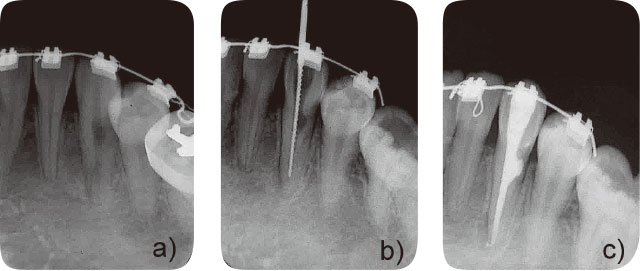 内部吸収歯に対するオブチュラⅡ根管充塡症例の画像