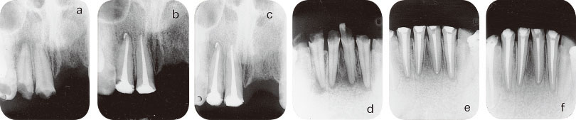 オーバー根管充塡症例の根尖歯周組織の変化の画像