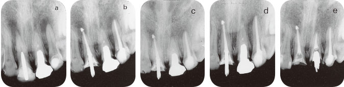オーバー根管充塡症例の根尖歯周組織の変化の画像