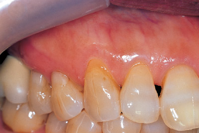 [写真] 右上顎犬歯歯頸部のクサビ状欠損の術前