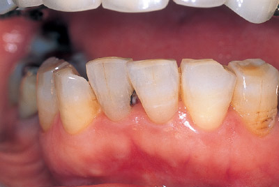 [写真] 下顎前歯の3級の術前