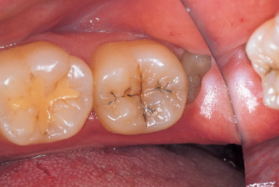 [写真] 左下顎第二大臼歯1級の術前