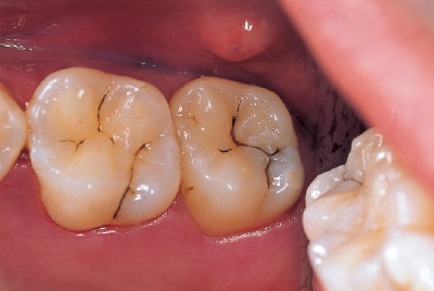 [写真] 右上顎第二大臼歯1級の術前