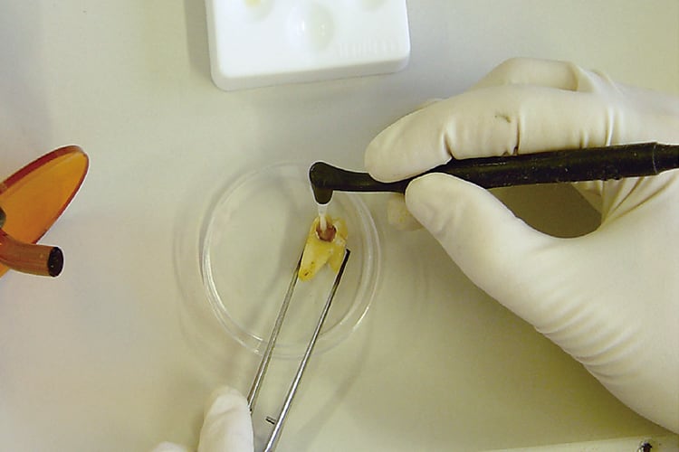 う蝕を有する抜去歯を用いた実験。残存させたう蝕象牙質に対してメガボンドFAによる処理を行った後、病変内の細菌の生存について検討した。