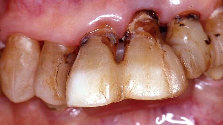 このような根面う蝕では、感染歯質の完全な除去は非常に困難である。