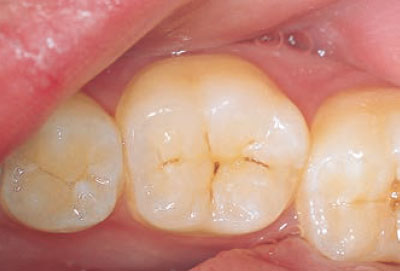 [写真] 下顎大臼歯咬合面の小窩裂溝う蝕の術前