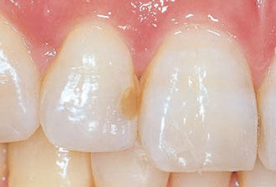 [写真] 上顎右側側切歯隣接面の二次う蝕の術前