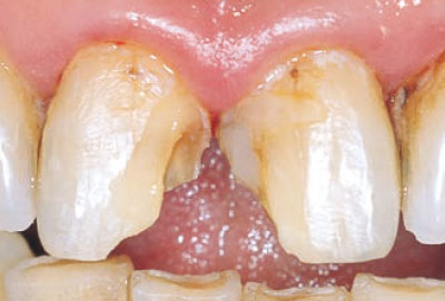 [写真] 上顎中切歯隣接面の修復物脱落、二次う蝕の術前