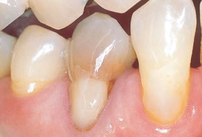 [写真] 右側第一小臼歯の変色歯の術前