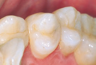 [写真] 上顎左第一小臼歯遠心隣接面のう蝕の術前