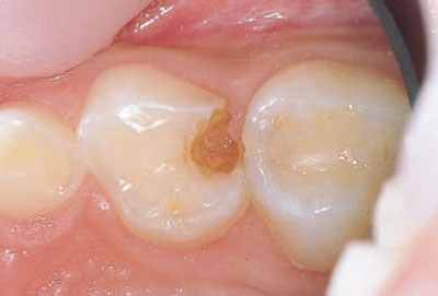 [写真] 上顎第一乳臼歯咬合面、遠心隣接面のう蝕の術前