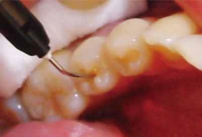 [写真] 象牙質に相当する部位にマジェスティLVのA2を充填
