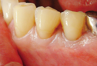 [写真] 4の歯頸部に充填されたコンポジットレジン周囲にう蝕をみとめる