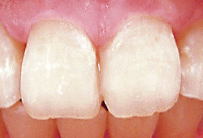 [写真] 窩洞唇側表層部に、マジェスティLVのE（エナメル）を充填