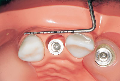 [写真] 前歯部では両隣接歯の唇側歯頸部を結ぶ仮想ラインをガイドとしてその舌側にインプラントを埋入する