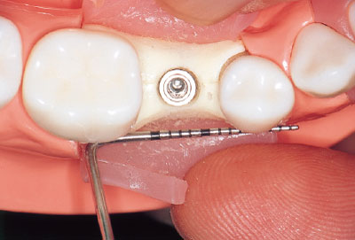 [写真] 臼歯部においても同じく歯列内に位置させる