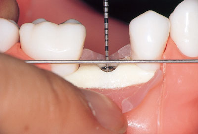 [写真] 歯肉歯槽粘膜の厚さと生物学的幅径に加えてインプラントの鏡面研磨面の幅を考慮した位置に設定する