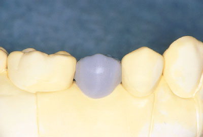 [写真] 天然歯の近遠心的幅径などを参考に歯列、歯頸線が調和するように診断用WAX-UPする