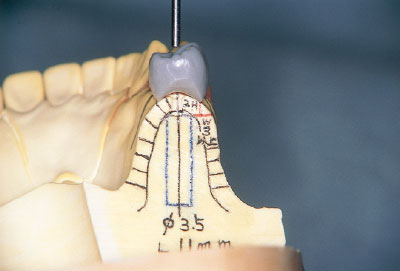 [写真] 前頭面での診断用WAX-UPの歯軸方向にあわせる