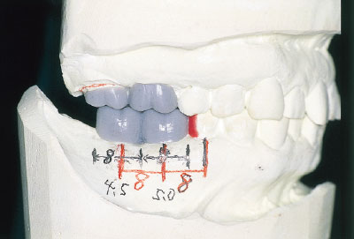 [写真] 歯科医師からの情報を基に診断用WAX-UPする