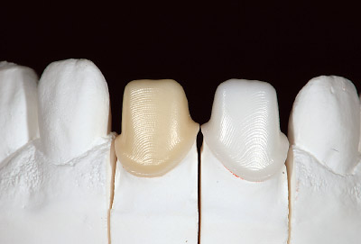 [写真]カタナシステムによって得られた中切歯2本のクラウンコーピング