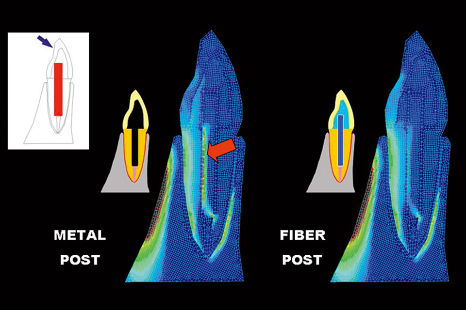 図2　有限要素法を用いた歯根部象牙質の応力解析