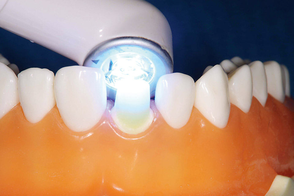 図3　歯頸部付近の光透過性