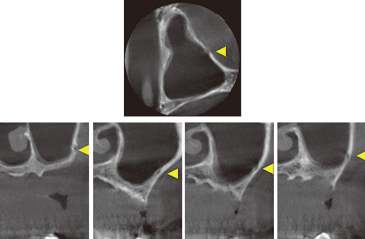 左上臼歯部のコーンビームCTによる3次元画像