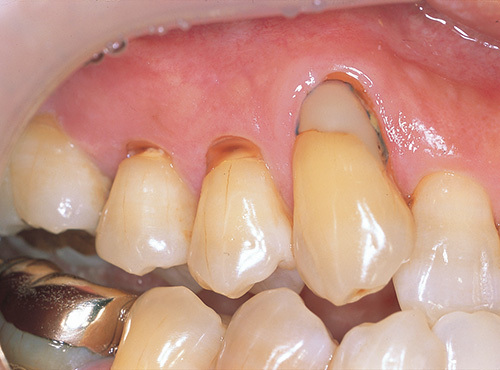 上顎右犬歯歯頸部の旧レジン修復の二次う蝕、および軽度の知覚過敏を示す小臼歯歯頸部クサビ状欠損の術前の写真