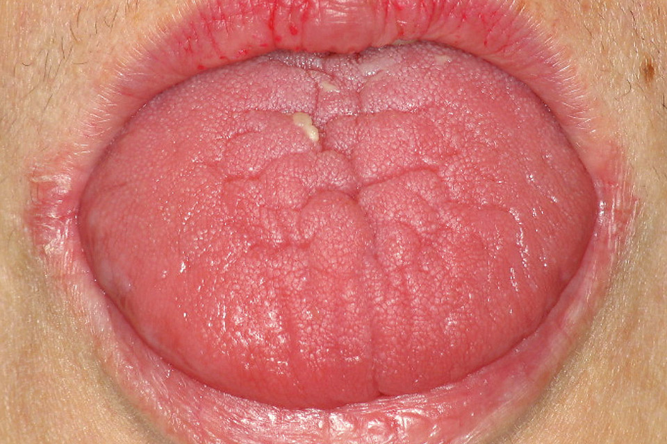 図8　溝状舌の例